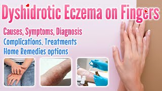 Dyshidrotic eczema on fingers overview causes symptoms treatment options and home remedies [upl. by Kala]