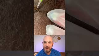 Derm reacts to INSANE ingrown hair extraction dermreacts doctorreacts ingrownhair [upl. by Zacharia504]