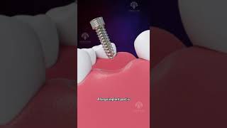 Bone Grafting for Dental Implants shorts facts  creativelearning3d [upl. by Barrada670]