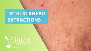 Blackheads Extractions “K’s” 4th Treatment [upl. by Suchta]