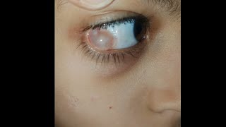 Hidden Swelling in eyes 👀  condition explained indetail eyecareoptom5506 eye eyelid swelling [upl. by Alket]