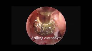 Endoscopic C67 foraminotomy microdiscectomy drilling of osteophyte [upl. by Euqinorev728]