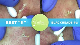 Blackheads Extractions Draven 7th Treatment [upl. by Saimon35]