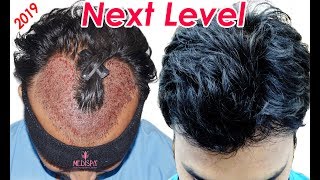 Best Hair Transplant in India  NW 36  Excellent Before After Results Medispa INDIA Dr Suneet Soni [upl. by Erfert]