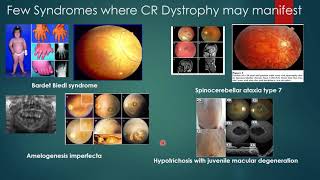 Cone Rod Dystrophy [upl. by Costanzia878]