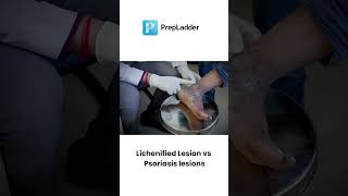 Psoriasis lesions vs Lichenified Lesions [upl. by Hadihsar425]