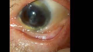 Ocular Cicatricial Pemphigoid [upl. by Ebbarta182]