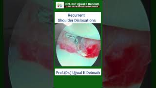 Recurrent Shoulder dislocation  Dr Ujjal kanti Debnath [upl. by Sineray743]