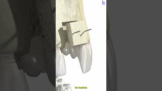 Bone Grafting Osteoporosis In Dental Implants 3D Animation [upl. by Airliah]