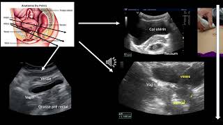 Echographie digestive visualisation du rectum Difficile [upl. by Yengac]