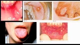 stomatitis mouth [upl. by Erbma857]