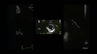 This Is What Atrial Fibrilation Looks Like On An Echocardiogram shorts [upl. by Thurmond]