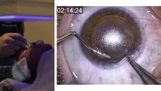 London Vision Clinic  ReLEx SMILE  Live laser eye surgery  Professor Dan Reinstein [upl. by Harlen]