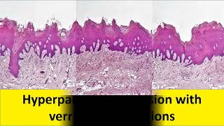 A Case of Proliferative Verrucous Leukoplakia [upl. by Anua336]