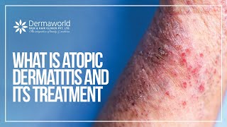 What is atopic dermatitis and its Treatment  Dr Rohit Batra  Dermaworld Delhi [upl. by Elleiad]