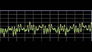 Autism Autistic DisordersRife Frequencies [upl. by Eoj]