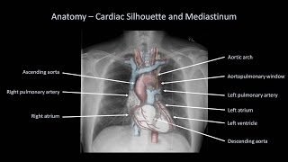 How to Interpret a Chest XRay Lesson 2  A Systematic Method and Anatomy [upl. by Omar]