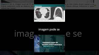 O que é Atelectasia atelectasia radiologia torax [upl. by Tumer729]