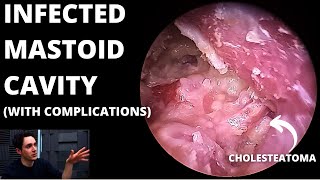 Infected Mastoid Cavity With Cholesteatoma Condylectomy May Be Needed [upl. by Ande]