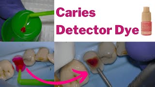 Is Caries Detector Dye BS Caries Removal investigated  PDP138 [upl. by Vaules]