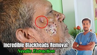 7YearOld Giant Blackhead Extraction Needle Method Revealed  alliedhealthscience skincare [upl. by Ecirtram434]