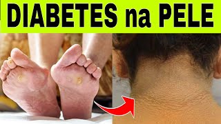 9 SINAIS de DIABETES na PELE [upl. by Brenda]