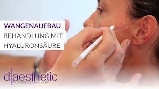 Wangenaufbau  Behandlung mit Hyaluronsäure  daesthetic [upl. by Oric]