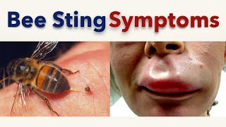 Bee Sting Symptoms [upl. by Maribelle]