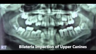 NonExtraction Treatment of Bilateral Impaction of Upper Canines  Dina 14yrs [upl. by Etterrag9]