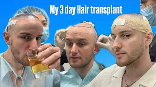 I got a hair transplant [upl. by Liagiba]