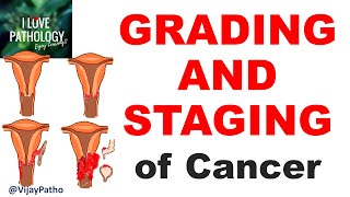 NEOPLASIA Part 11 GRADING and STAGING of cancer [upl. by Elery]