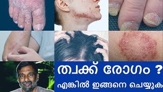 Psoriasis  Skin diseases treatment  Mohanan Vaidyar [upl. by Natan]