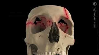 Volumated Skull Fractures [upl. by Ashjian]