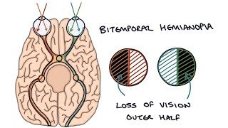 Bitemporal hemianopsia  Bitemporal Hemianopia  Drk [upl. by Nutsud]