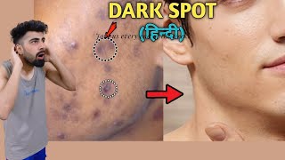 How To Remove DARK SPOTS From Face Naturally  Mridul Madhok [upl. by Darice]