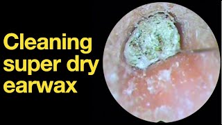 Cleaning super dry earwax ear wax removal  ear cleaning  ASMR  relaxation  relax [upl. by Zahc]