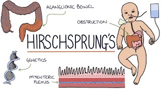 Hirschsprungs Disease [upl. by Nyvrem]