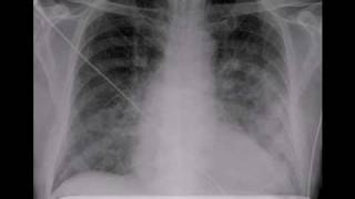 Chest xray Pulmonary edema lungs [upl. by Oiligriv]