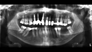 für Zahnärzte das OPTG Röntgen [upl. by Aihsek]