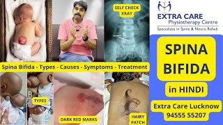 SPINA BIFIDA in Hindi  स्पाइना बिफिडा  कारण लक्षण व इलाज  Full Detailed Video  Extra Care [upl. by Anikehs]