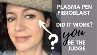 BEFORE amp AFTER PLASMA FIBROBLAST DIARY1 WEEK RESULTS LORRY HILL [upl. by Nerhe]