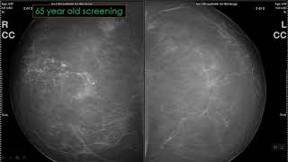 Approach to Calcifications on Mammography [upl. by Hurff164]