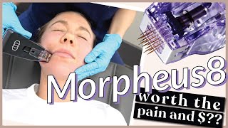 TREATMENT RECOVERY AND INITAL REVIEW OF THE MORPHEUS8 ANTIAGING RADIO FREQUENCY MICRONEEDLING TX [upl. by Askari432]