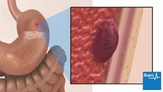 How a peptic ulcer develops  Bupa Health [upl. by Hollingsworth]