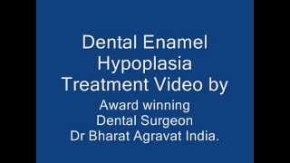 Dental Teeth Enamel Hypoplasia Video by Award winning Dental Surgeon Dr Bharat Agravat India [upl. by Leahcimnhoj]