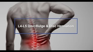 L4L5  स्लिप डिस्क का इलाज Slipped Disc Treatment रीढ़ की हड्डी में L4L5 स्लिप डिस्क है बहुत कॉमन [upl. by Annabelle817]