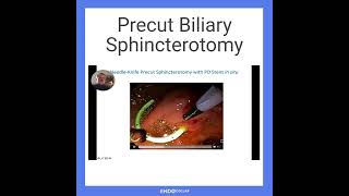 Precut Biliary Sphincterotomy [upl. by Aya]