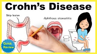 Crohns disease Symptoms pathophysiology diagnosis treatment mnemonic Quick review [upl. by Nnylsaj340]