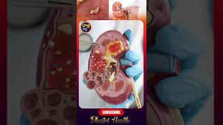 kidney stones kidney stones healthylifestyle doctor healthtips information dhatrihealth [upl. by Cinemod230]