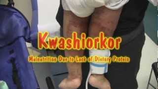 Kwashiorkor [upl. by Ahsekat]